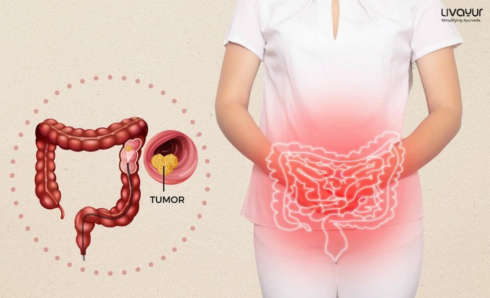 Colorectal Cancer Colorectal Cancer