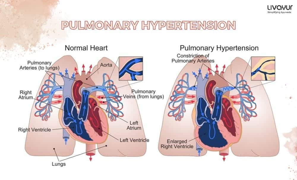 PULMONARY HYPERTENSION (1) PULMONARY HYPERTENSION 1