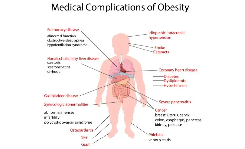 21-10 obesity treatment